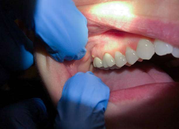 Best Dental Abscess Treatment in New Market, VA